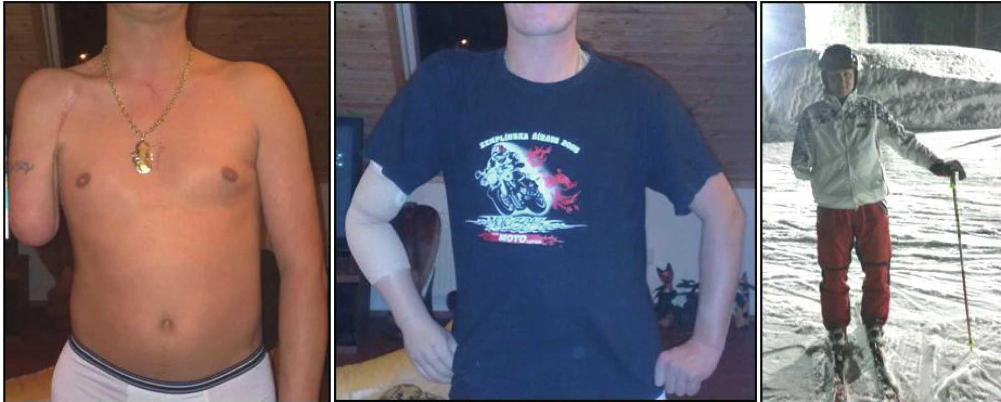 10 let po úraze
