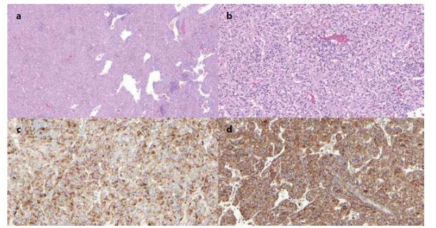 Histologické řezy preparátu angiomyolipomu
2a − Hematoxylin-Eosin barvení, zvětšení 5×; 2b − Hematoxylin-Eosin barvení, zvětšení 200×;
2c − HMB-45 imunohistochemické barvení, zvětšení 200×; 2d − Cathepsin K imunohistochemické barvení, zvětšení 200×.<br>
Fig. 2: Histological samples of the angiomyolipoma specimen
2a − Hematoxylin and eosin staining, magnification 50×; 2b − Hematoxylin and eosin staining, magnification 200×; 2c − HMB-45
immunohistochemical staining, magnification 200×; 2d − Cathepsin K immunohistochemical staining, magnification 200×.