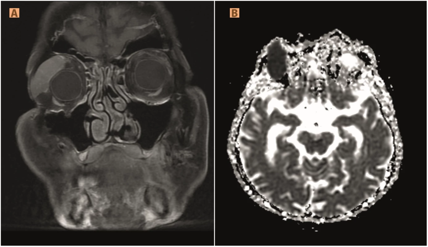  Lymphoma affecting the lachrymal gland: (A) post-contrast hypersignal in T1FS, (B) hyposignal in ADC map
