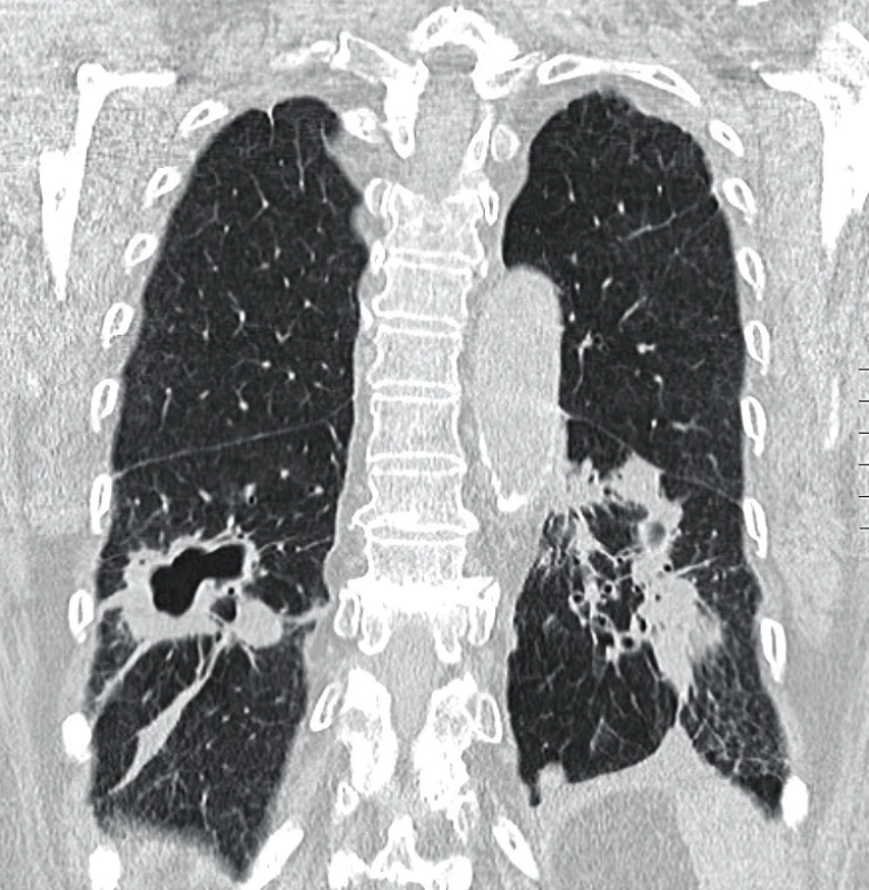 HRCT plic (high-resolution computer tomography – výpočetní
tomografie s vysokým prostorovým rozlišením) s obrazem
nodulací a kavitovaných lézí, fibrózních pruhů, pleurálních plastických
změn s trakčními bronchiektáziemi u granulomatózy s polyangiitidou
(Radiologická klinika FN, Olomouc)