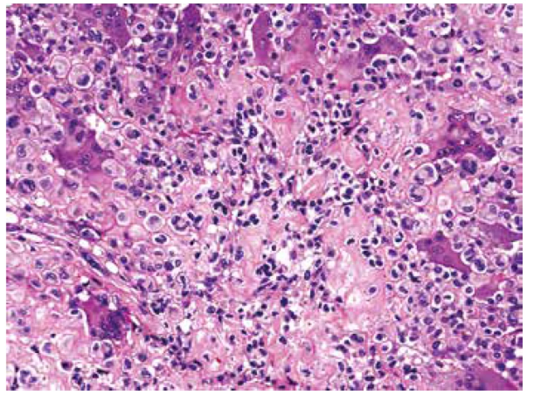 V HE barvení bylo místy prakticky nemožné určit pravou podstatu
extracelulární matrix, resp. vyloučit drobná depozita osteoidu od převládající
chondroidní komponenty (HE, 200x).