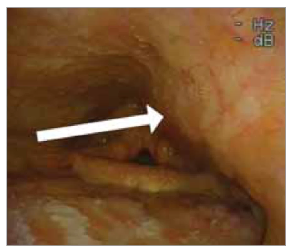 Pulzující vyklenutí laterodorzální
stěny orohypofaryngu.<br>
Fig. 8. Pulsating arching of the laterodorsal
wall of the orohypopharynx.