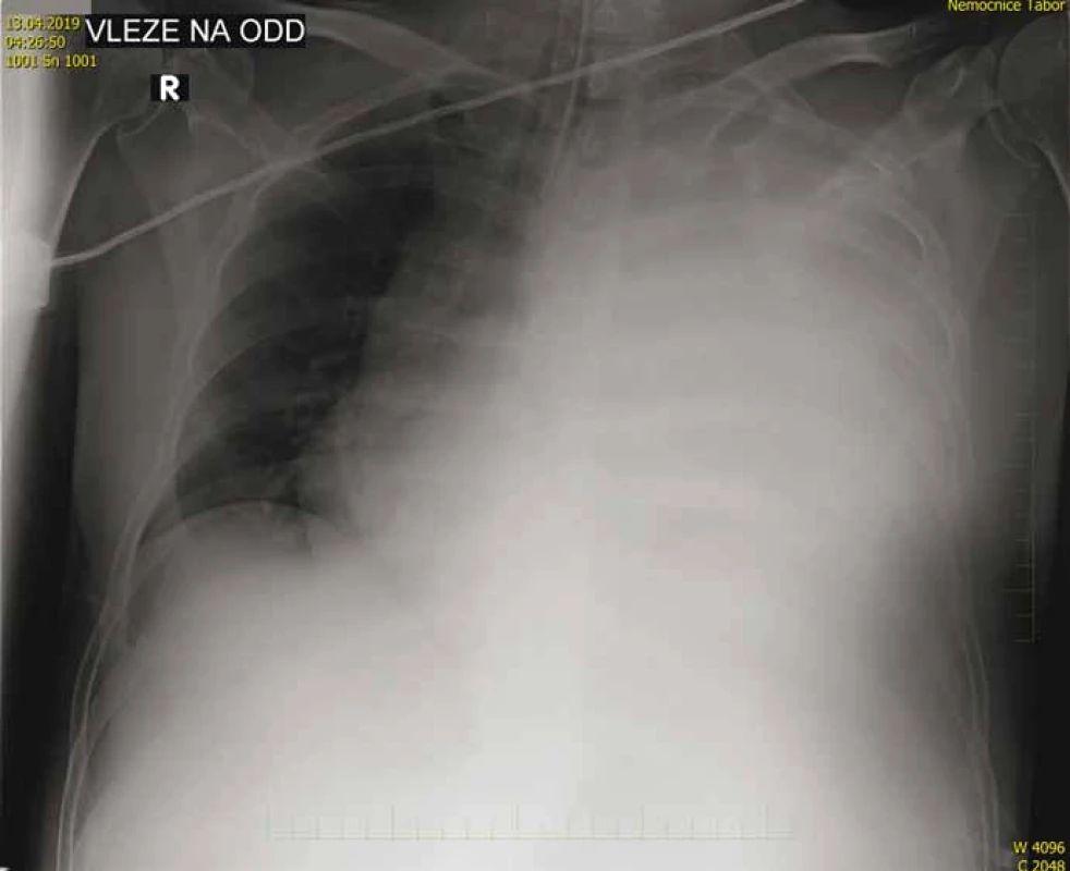 Kontrolní RTG snímek hrudníku – zastření levostranného hemithoraxu s
přetlakem mediastina doprava.<br>
Fig. 3. Control X-ray of chest – obstruction of left hemithorax with mediastinal pressure
to the right.