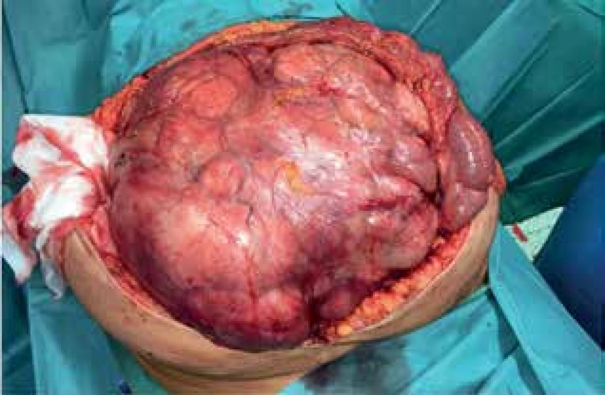 Peroperační nález I (liposarkom)<br>
Fig. 11: Peroperative finding I (liposarcoma)