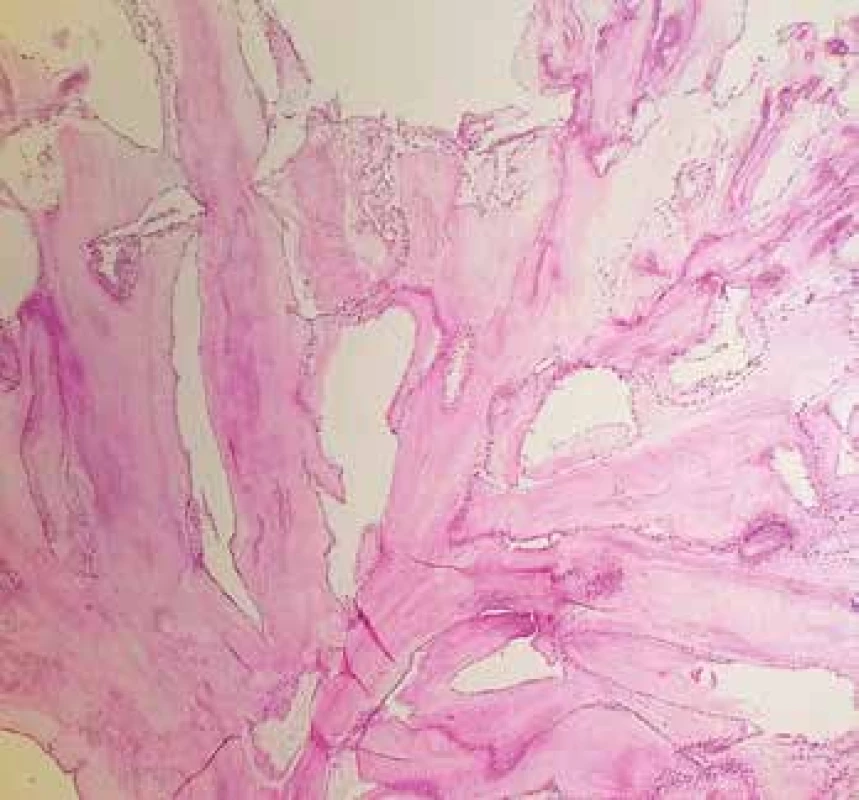Papilární fibroelastom filiformní úpravy s  centrálním jádrem bohatým na elastiku a řidším pojivem na periferii (Weigertův resorcin-fuchsin, 100x).