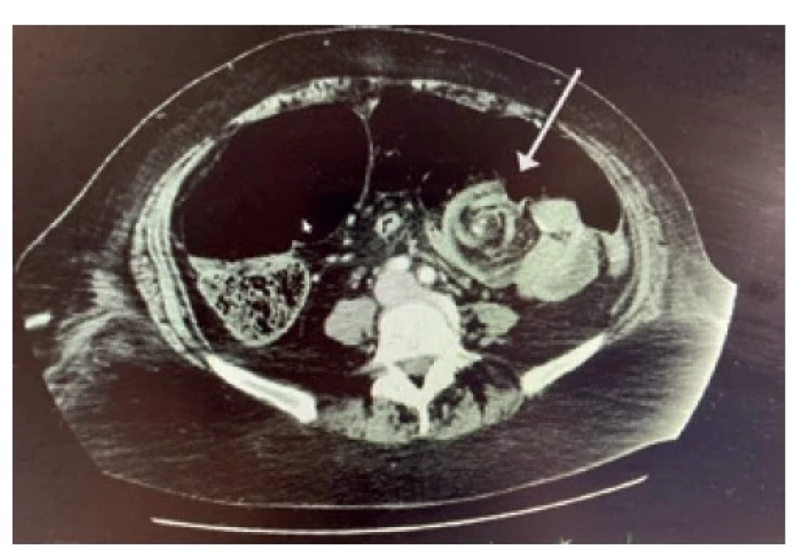 Šipka směřující na typický obraz CT, vír mezenterických
cév<br>
Fig. 2: Arrow pointing to mesenteric whirl signs, typical
CT findings