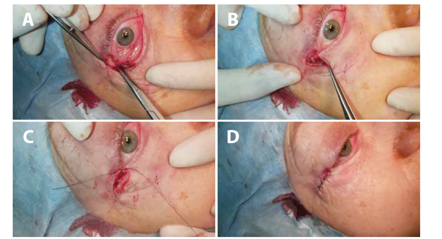 (A) Ektropium pravého oka – vizualizace periostu, (B) fixace proužku tarzu k periostu, (C) první steh zachovávající ostrý
úhel, (D) sutura kůže