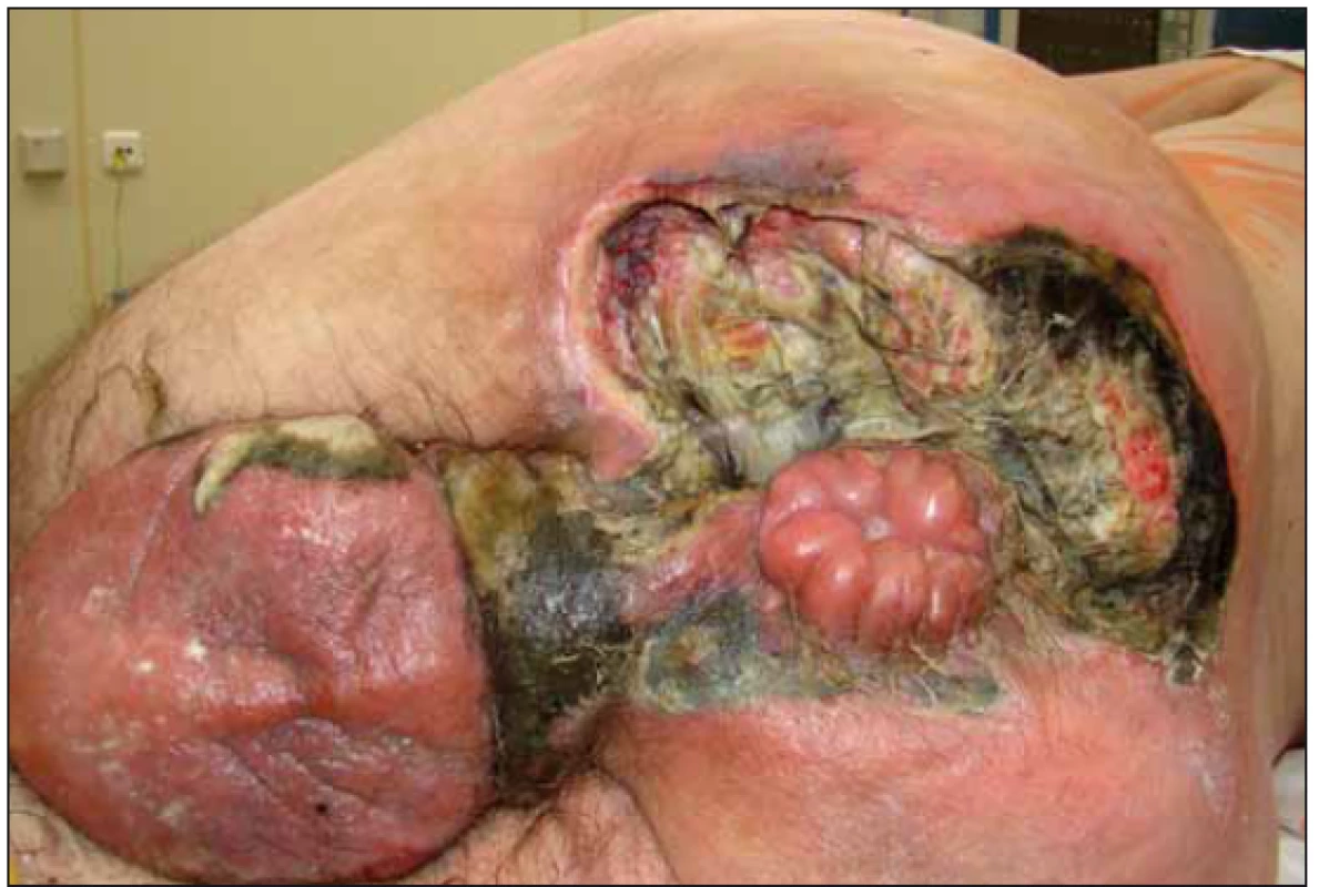 Druhá nekrektomie.<br>
Fig. 2. Second necrectomy.