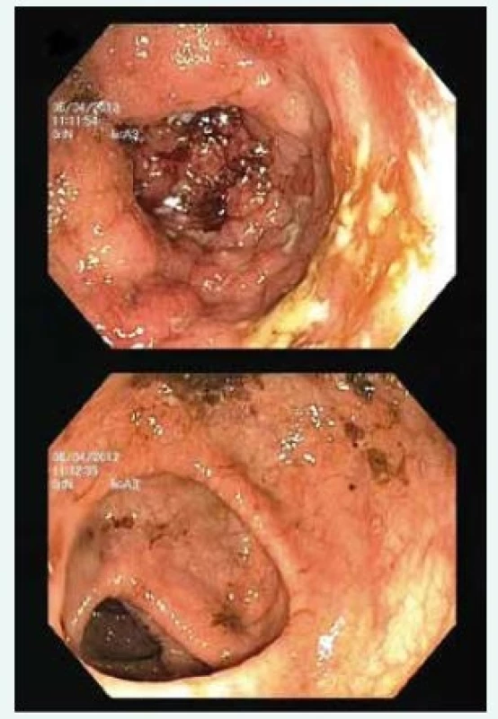 Endoskopický nález u PSC-IBD: extenzivní
kolitida s pravostrannou predominancí
zánětlivých změn. Aktivní zánět v céku
(nahoře) s úbytkem inflamatorních změn
distálním směrem (dole)