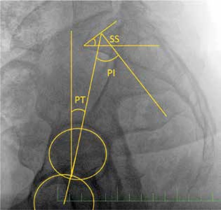 Spinopelvické parametry
SS sacral slope; PI pelvic incidence; PT pelvic tilt. PI=PT+SS<br>
Fig. 7: Spinopelvic parameters
SS sacral slope, PI pelvic incidence, PT pelvic tilt. PI=PT+SS