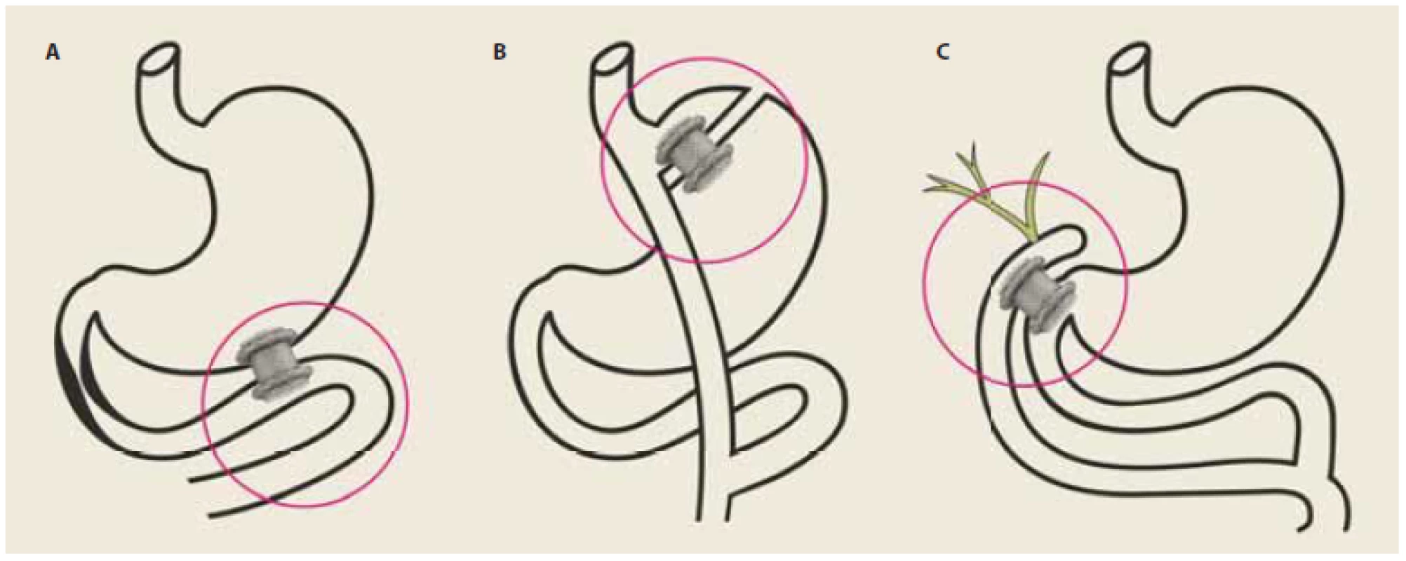 EUS navigované gastrointestinální anastomózy.<br>
A – Organická stenóza proximálního duodena. EUS-GEA v oblasti Treitzova ligamenta – na distální duodenum nebo
první kličku jejuna. B – Roux-en-Y gastrický bypass. EUS-GGA k provedení ERCP. C – Roux-en-Y hepatikojejunoanastomóza.
EUS-DJA k provedení ERCP.<br>
EUS-GEA – endosonografi cky navigovaná gastroenteroanastomóza, EUS-GGA – endosonografi cky navigovaná gastrogastroanastomóza,
ERCP – endoskopická retrográdní cholangiopankreatografi e, EUS-DJA – endosonografi cky navigovaná
duodenojejunoanastomóza<br>
EUS guided gastrointestinal anastomoses.<br>
A – Organic stenosis of the proximal duodenum. EUS-GEA in the area of the Treitz ligament – to the distal duodenum or the
fi rst loop of jejunum. B – Roux-en-Y gastric bypass. EUS-GGA to implement ERCP. C – Roux-en-Y hepaticojejunoanastomosis.
EUS-DJA for ERCP.