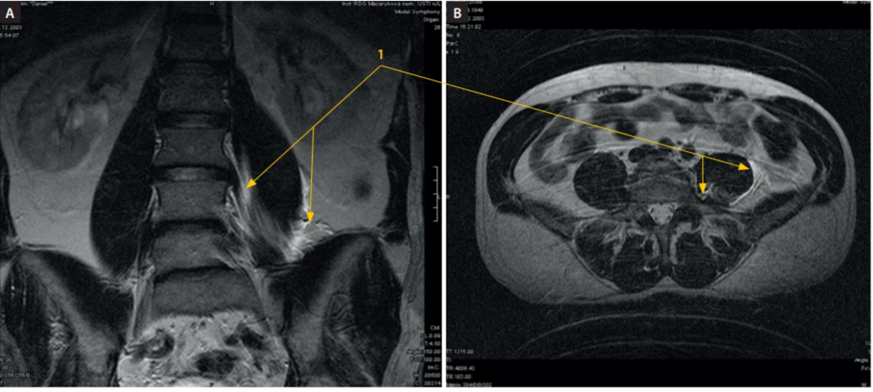 MRI dutiny břišní, vertikální řez, po podání 20 ml fyziologického roztoku cestou psoas compartment blok ve výši L2–3 vlevo a 20 ml fyziologického
roztoku cestou infrainquinálního femorálního bloku (3 in 1) vpravo. A: Na vertikálním řezu je patrná náplň psoatického a iliopsoatického kompartmentu
z mediální a laterální strany m. psoas major (1). B: Na horizontálním řezu z téhož vyšetření je patrná náplň kraniální části psoatické fascie na mediální,
dorsální a laterální části (1). Kraniokaudálním směrem byla náplň identifikovatelná na rozhraní L5–S1