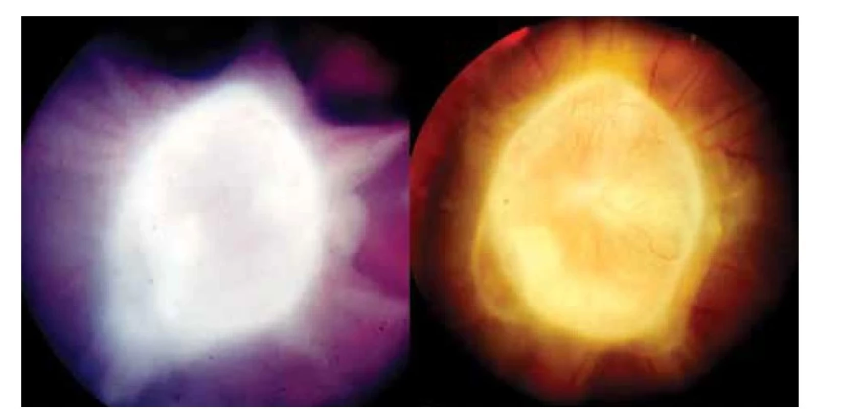 Vlevo: Cystický granulom hlavy zrakového nervu toxokarové etiologie s vitreálními
pruhy před celkovou terapií<br>
Vpravo: Cystický granulom hlavy zrakového nervu toxokarové etiologie s  kapilárami na
jeho povrchu půl roku po kombinované léčbě