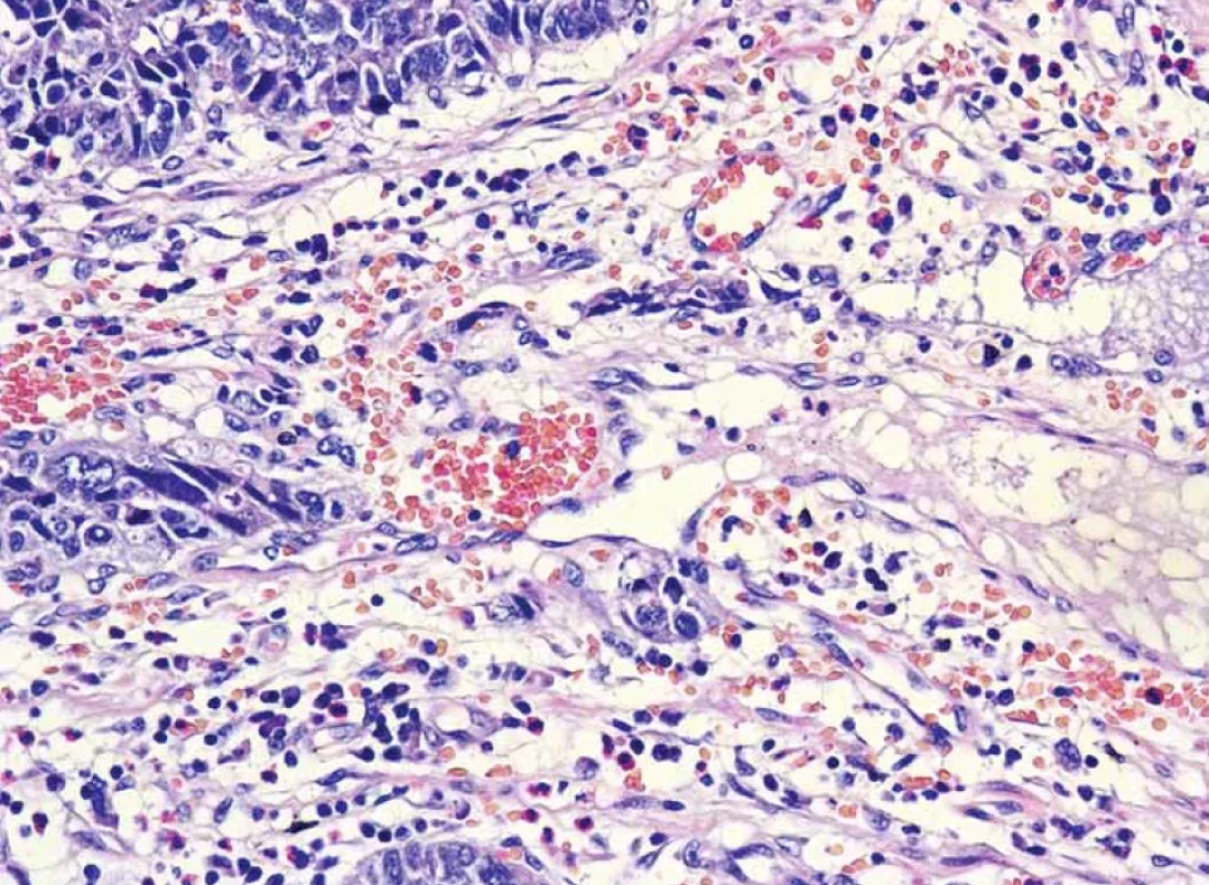 Pronikání karcinomu do malé cévy, nejspíše lymfatické – lymfangioinvaze (barvení hematoxilin-eozin).</br>Fig. 12. Penetration of cancer into a small vessel, most likely lymphatic – lymphangioinvasion (hematoxylin-eosin staining).