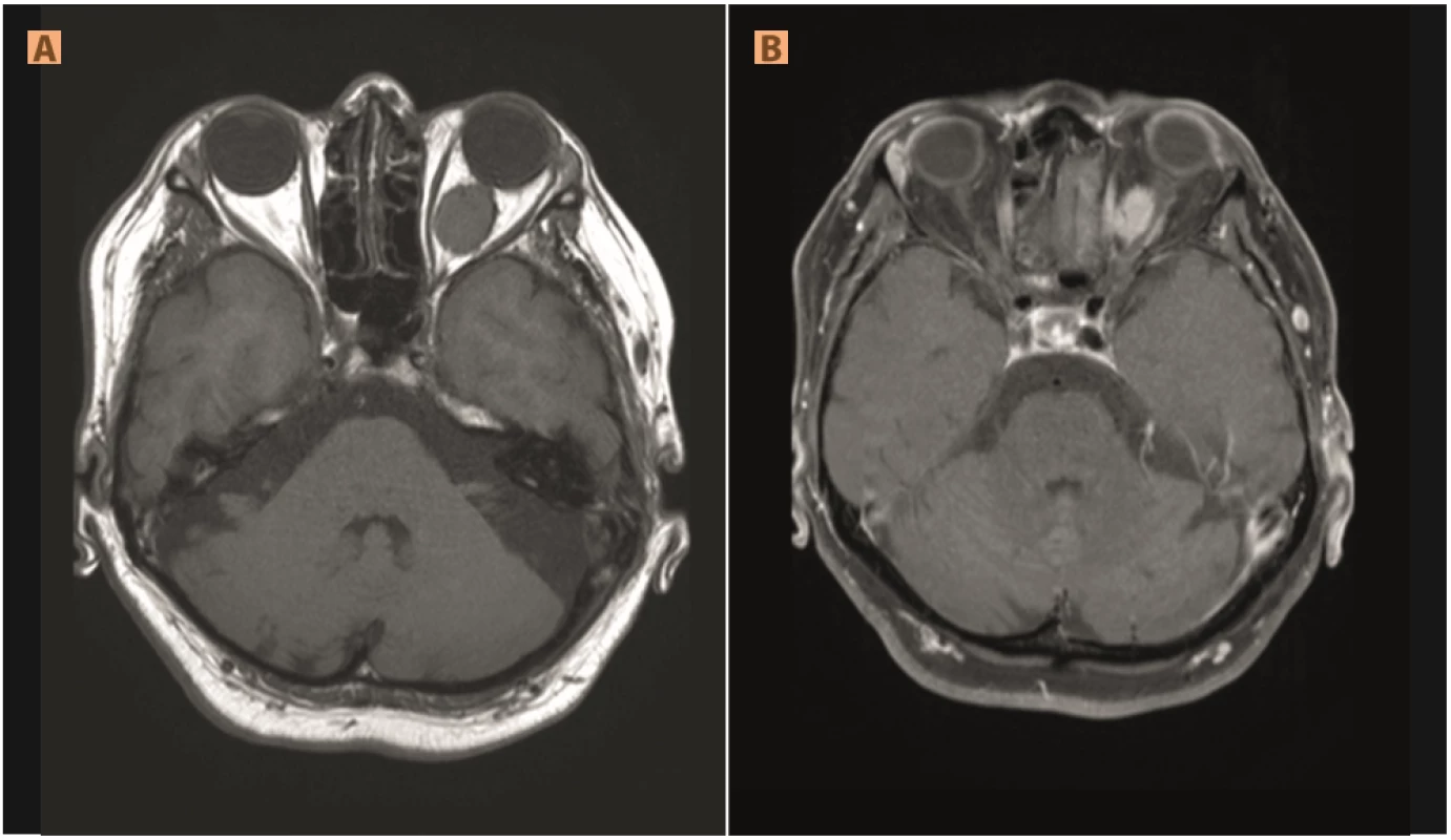 Meningeoma of optic nerve sheath: sharply bordered formation encasing optic nerve, (A) isosignal in T1WI and (B) post-contrast saturated in T1SPIR
