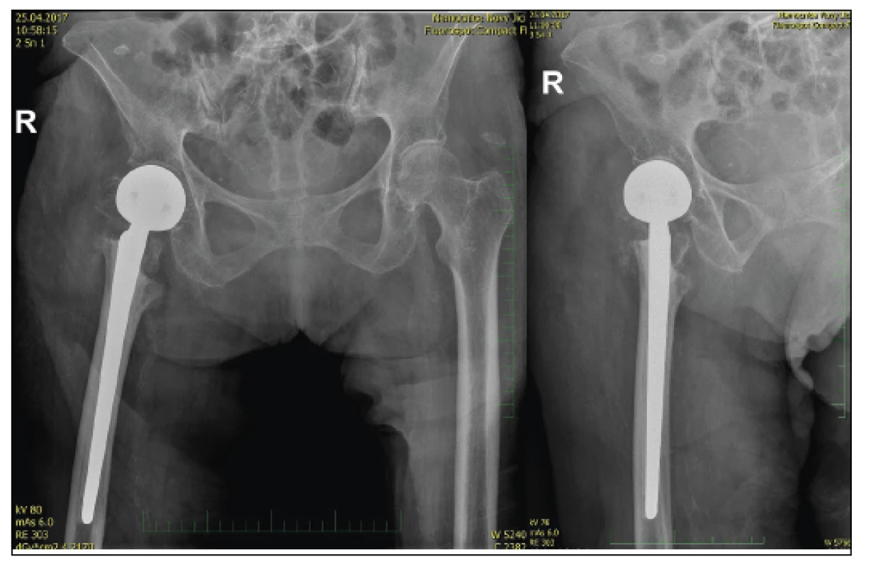 87letá žena s patologickou zlomeninou trochanterického masivu,
kontrolní RTG po implantaci CKP s dříkem Centrament