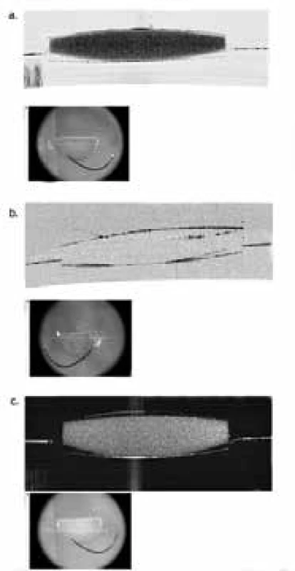 Cross-sections with the aid of anterior segment
OCT in vitro – a. homogeneous light dispersion (“scattering
effect”) on explanted IOL, b. disappearance of light
dispersion on dried IOL and c. light dispersion on rehydrated
IOL, which demonstrates that this concerns hydrophilic
material