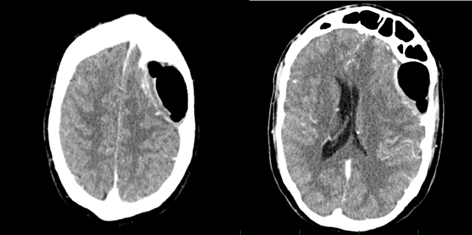 Postoperative CT scan with contrast medium showing regression of finding.<br>
Obr. 3. Pooperační CT vyšetření s kontrastní látkou ukazující regresi nálezu.

