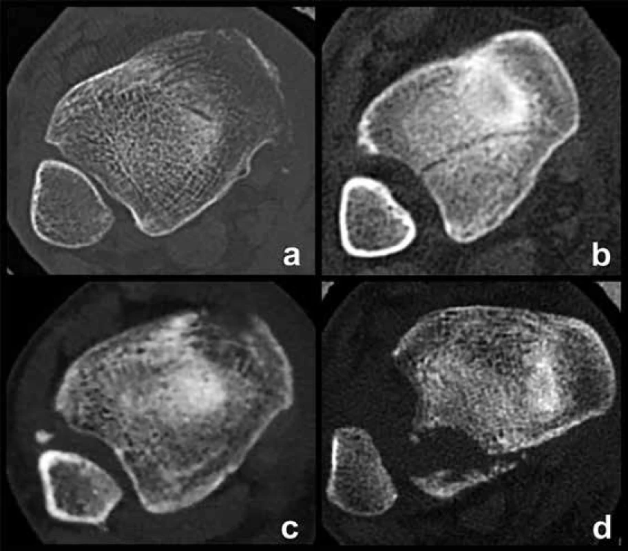 Postavení fibuly v incisura fibularis tibiae na transverzálních
CT řezech provedených 5 mm nad kloubní štěrbinou hlezna
a – normální postavení, b – rozšíření tibio-fibulární štěrbiny, c – zevní rotace
fibuly a rozšíření štěrbiny, d – výrazná dislokace fibuly z incisury.<br>
Fig. 6. Position of the fibula in the fibular notch in transverse CT scans
5 mm above the joint line of the ankle
a – normal position; b – widening of the fibular notch; c – external rotation
of the fibula and widening of the tibiofibular space; d – marked
displacement of the fibula from the fibular notch.