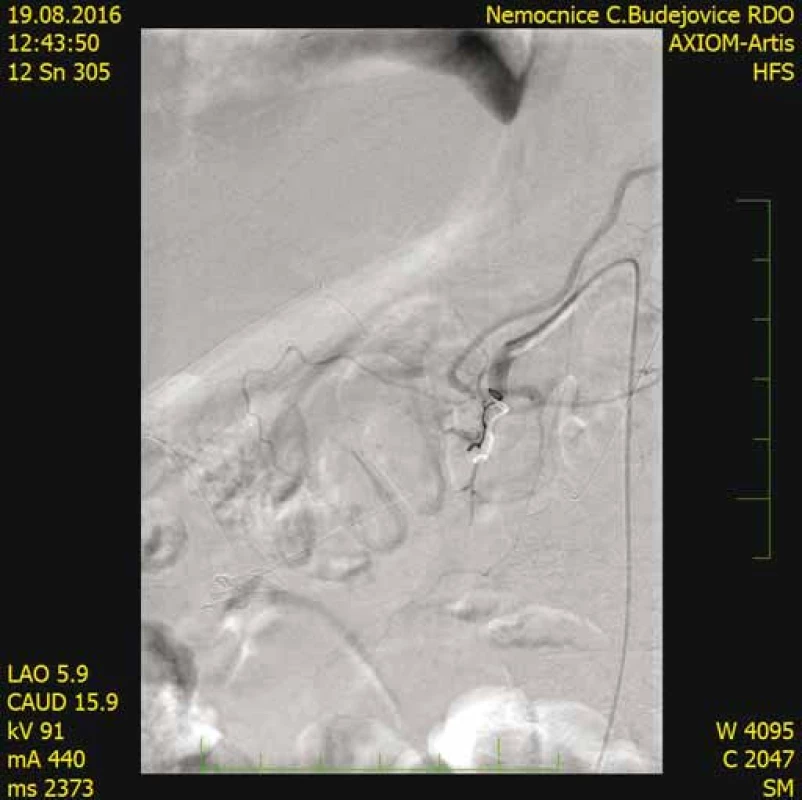 CT angiografi a (po embolizácii arteria gastroduodenalis)
bez nálezu patologickej vaskularizácie v oblasti
hlavy pankreasu.<br>
Fig. 10. CT angiography (after embolisation of arteria
gastroduodenalis) shows no pathological vascularisation
in the region of the pancreas head.