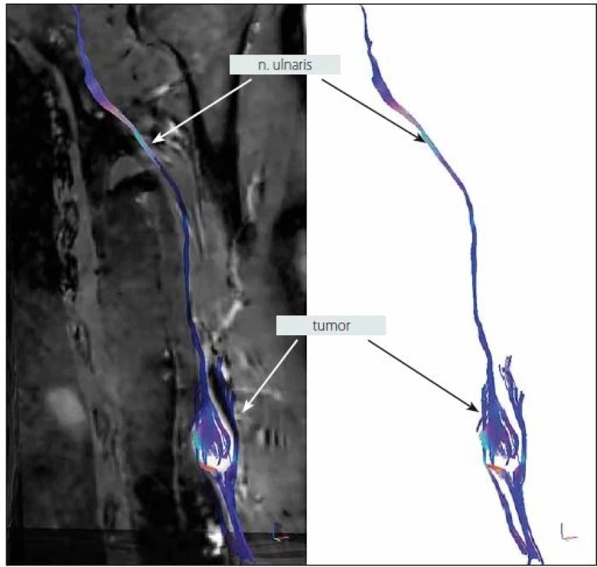 MR traktografie nervus ulnaris s tumorem v oblasti levé distální paže zachycující rozprostření fasciklů na povrchu tumoru (muž, 64 let).<br> Fig 2. MR tractography of the ulnar nerve with a tumor in the distal left arm capturing the spread of the fascicles on the tumor surface (male, 64 years).