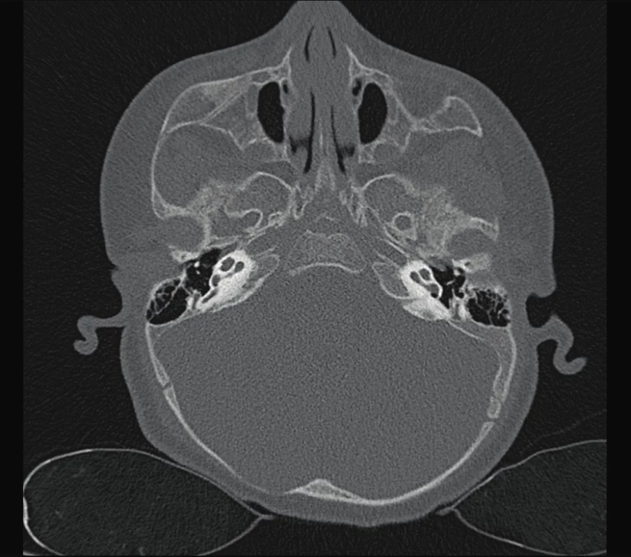 Mondiniho malformace kochley.<br>
Fig. 4. Mondini malformation of kochlea.