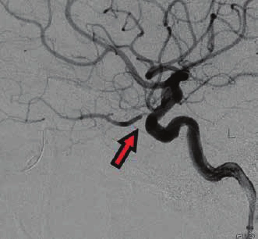 Restoration of blood supply in arteria ophthalmica
and arteria centralis retinae (ACR) in left eye. The arrow
indicates stenosis by the exit of the arteria ophthalmica