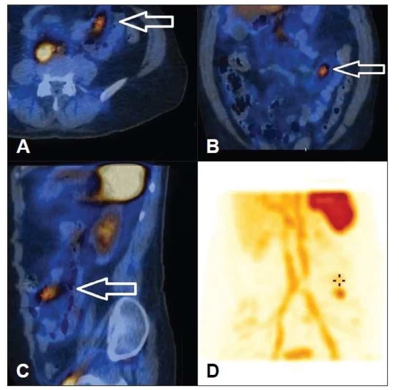 Obraz SPECT/ldCT se záchytem extravazace aktivity v oblasti proximálního
jejuna (A – transverzální řez, B – frontální řez, C – sagitální řez, D – 3D obraz).