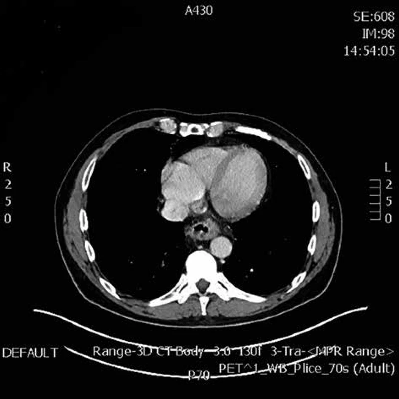 kontrolní PET/CT v rámci restagingu po neoadjuvantní
radiochemoterapii (transversální řez)<br>
Fig. 1: PET-CT in restaging after neoadjuvant chemoradiotherapy
(sagital reconstruction)