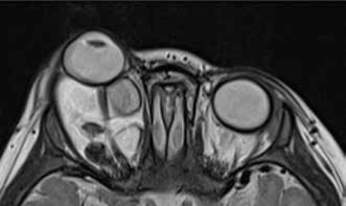 MRI vyšetření v 10. měsíci věku s patrnou protruzí
pravého bulbu a napnutím optického nervu