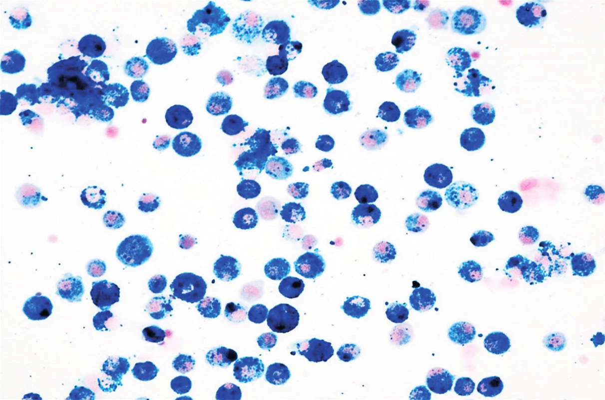 Cytologické vyšetrenie materiálu z bronchoalveolárnej
laváže – farbenie na železo zachytávajúce histiocyty
naplnené hemosiderínom, zväčšené 40x.<br>
Fig. 1. Cytological examination of material from bronchoalveolar
lavage – pigmentation on iron capturing histiocytes
filled with hemosiderin, increased 40x.