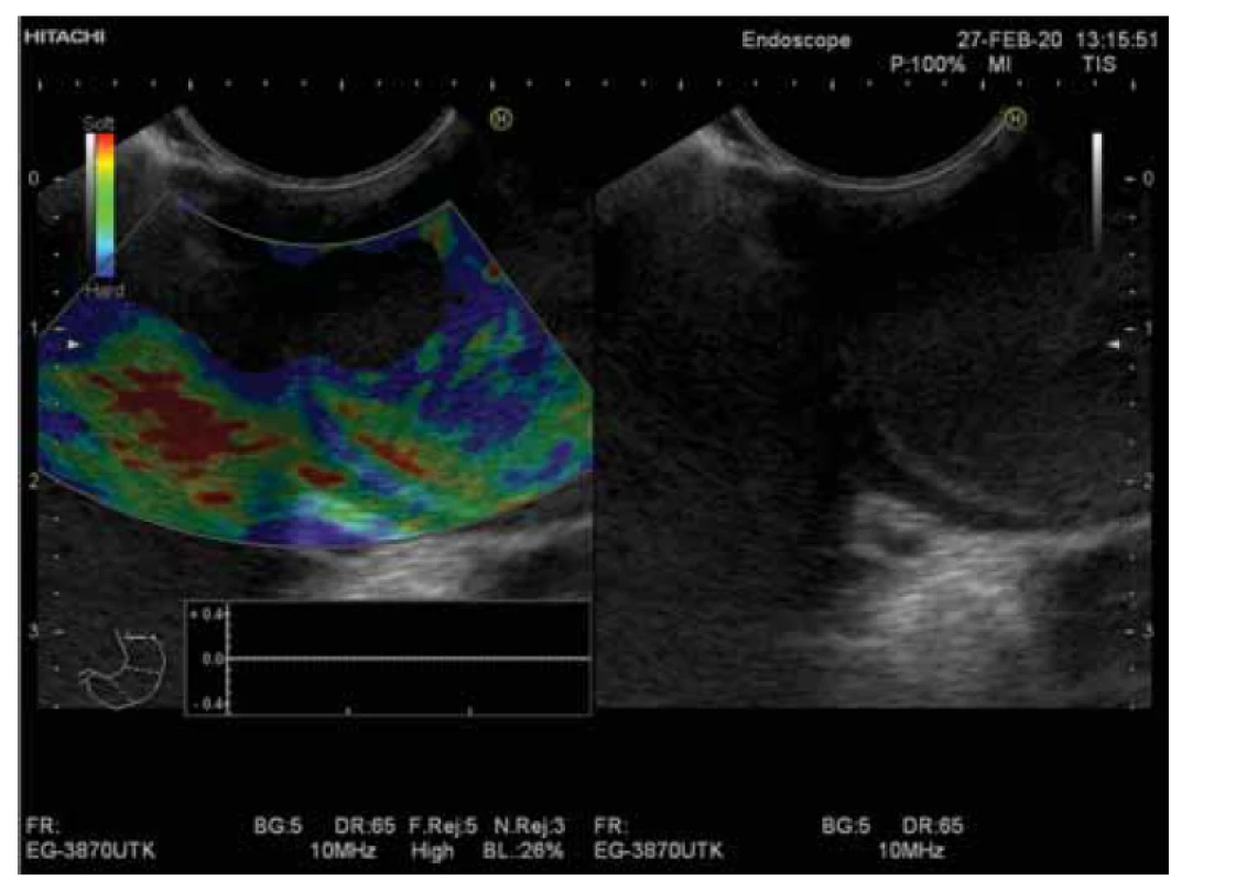 Duplikačná cysta ezofágu v elastografickom zobrazení (strain elastografy)
– typické 3-farebné zobrazenie s haló výpadkom.<br>
Fig. 3. Esophageal duplication cyst in elastographic imaging (strain elastographs) –
typical 3-color imaging with halo dropout.