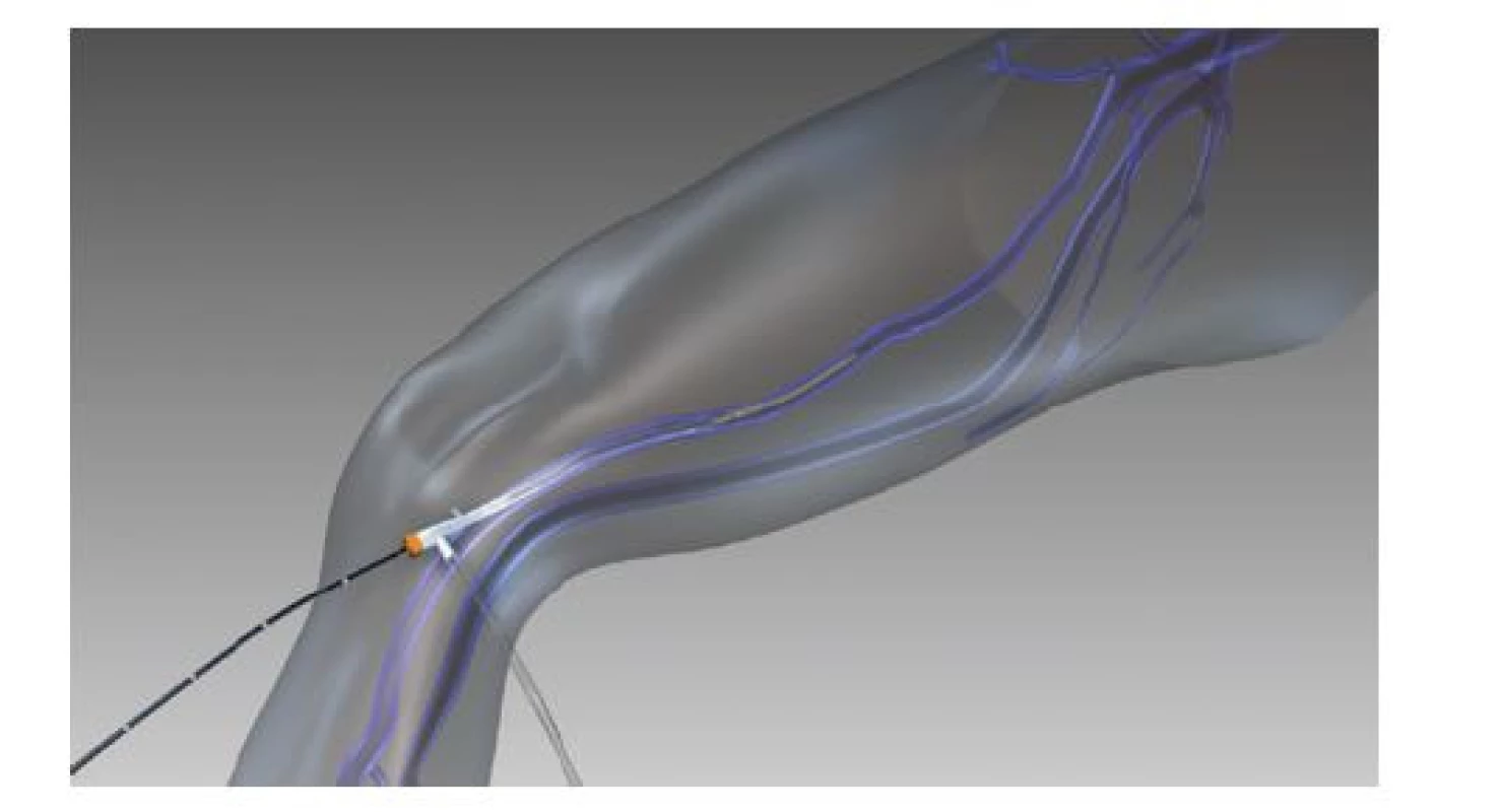 Schéma zavedeného radiofrekvenčního katétru
s tepelným článkem (publikováno se souhlasem firmy
Medtronic)<br>
Fig. 7: Schematic of an inserted radiofrequency catheter
with a thermal cell (published with permission from Medtronic)