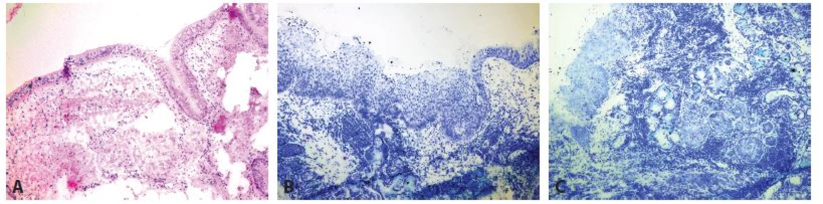 Peroperační bronchiální resekční linie. A: Normální nález (zvětšení 40x, HE). B: High grade dysplázie (zvětšení 40x, Toluidinová modř). C: Mikroinvazivní
karcinom a karcinom in situ (zvětšení 40x, Toluidinová modř).