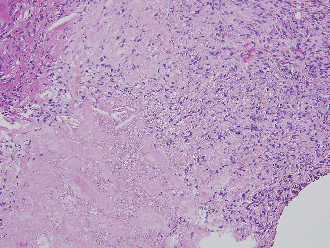 Nekrobiotický xantogranulom – histopatologický obraz
