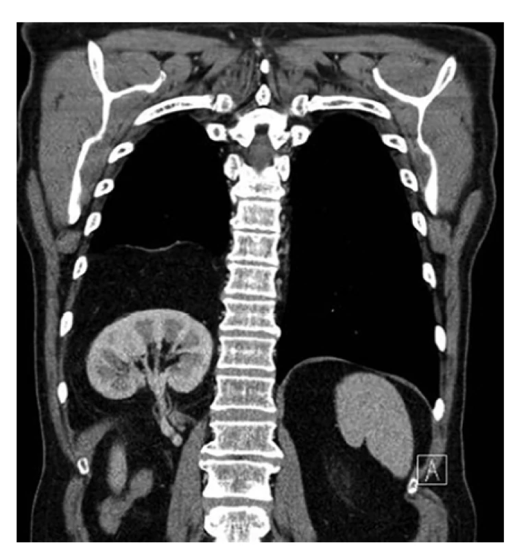 Nativní CT hrudníku a břicha jasně patrná
brániční kýla<br>
Fig. 3. CT scan of cheat and abdomen, clearly evident
diaphragmatic hernia