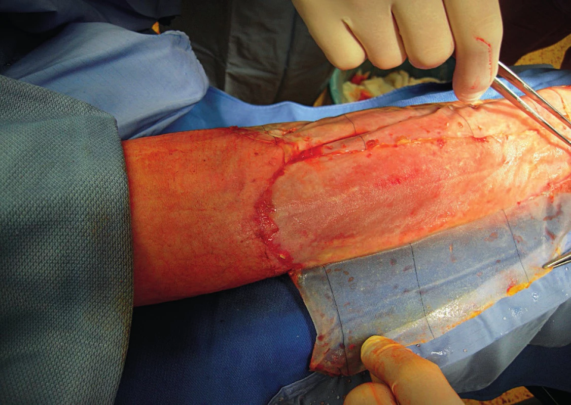 Removal of the outer silicone layer 21 days after Integra® application