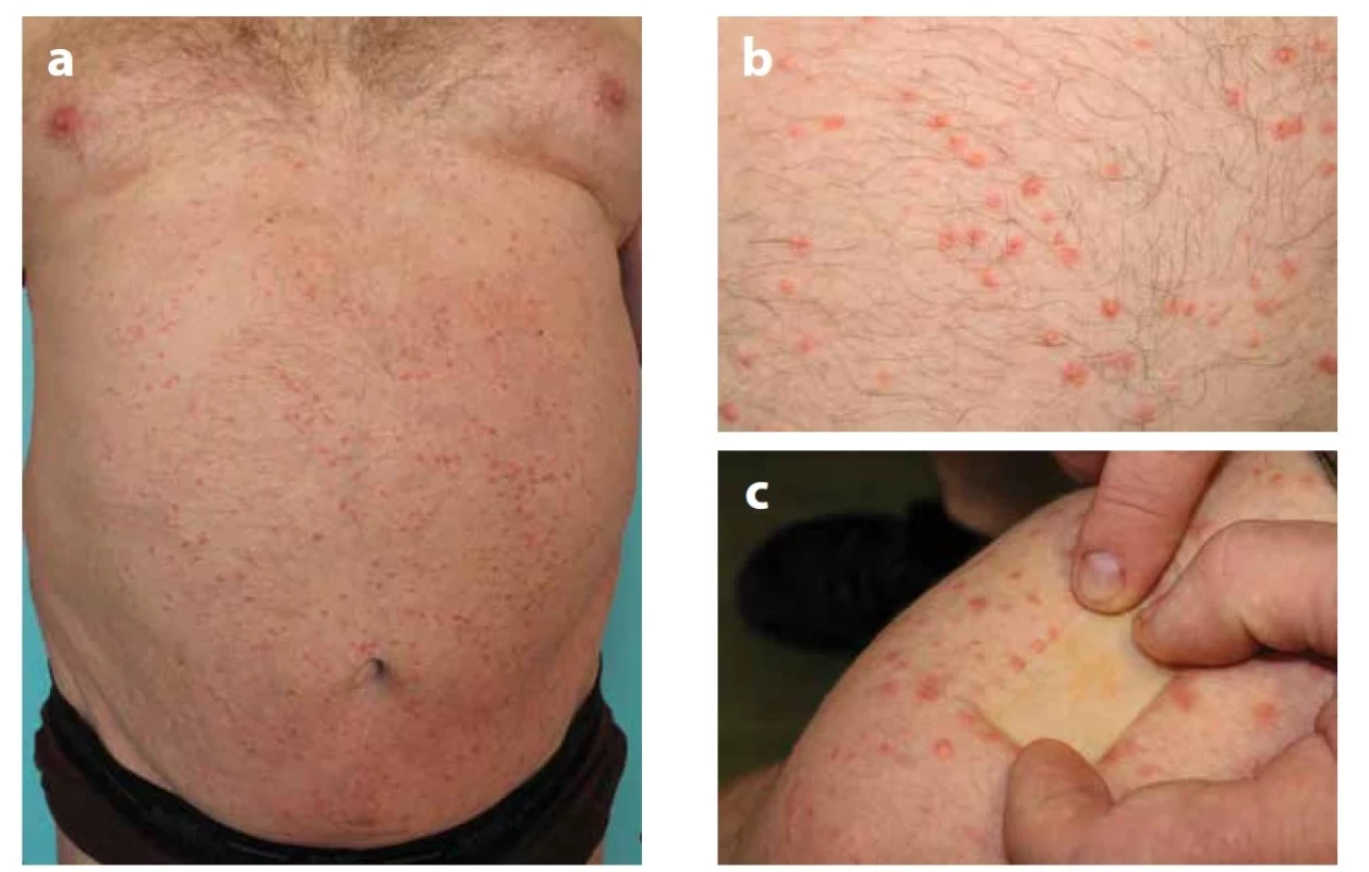 a, b, c. Xanthoma eruptivum<br>
Výsev papul (a, b) žlutavě prosvítajících při vitropresí (c).