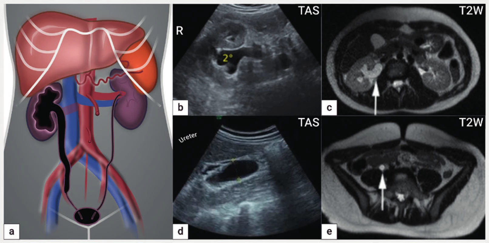 Dilatovaný ureter a hydronefróza<br>
Schéma hydronefrózy vpravo druhého stupně s dilatací pánvičky a
kalichů (a), ultrazvukový nález hydronefrózy 2° (b) a hydroureteru
vpravo (d), nález z magnetické rezonance s detekcí hydronefrózy 2°
(šipka) (c) a hydroureteru (šipka) (e)
R – ren, TAS – transabdominální sonografie, T2W – T2 vážené obrazy
v magnetické rezonanci