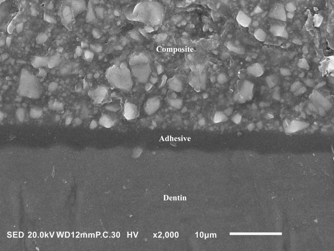 A cross-sectional view of the adhesive joint between dentin and a hybrid resin composite formed by a thin (~5 μm) adhesive layer of the universal adhesive G-Premio Bond (GC, Tokyo, Japan). Scanning electron microscope, magnification 2000×.