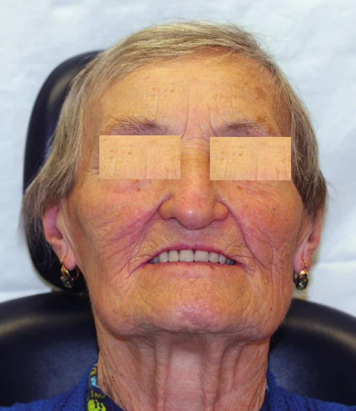Prosthetic rehabilitation of a maxilla defect with an obturator in a female senior patient (author’s archive)