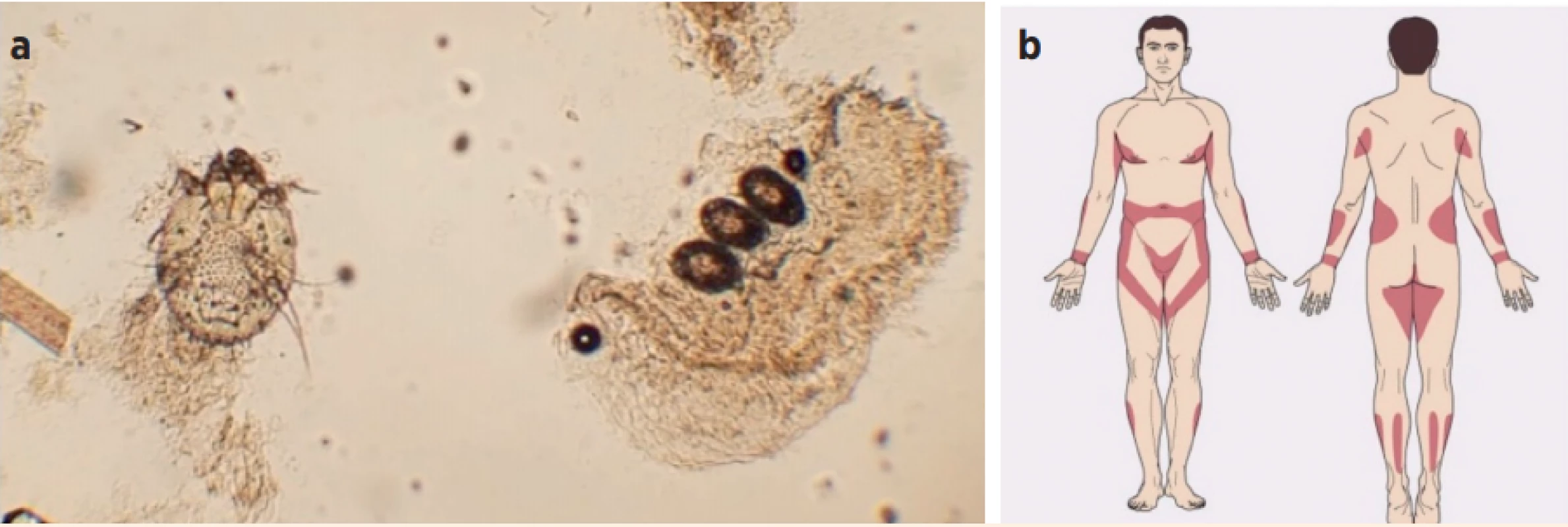  a) Samička zákožky svrabové v louhovém preparátu, vpravo 3 vajíčka (zdroj: Veasey JV. Diagnostic methods for scabies.
Surg Cosm Derm 2018).
b) Typická distribuce zákožky svrabové (predilekční lokalizace) u dospělého člověka postihující zápěstí, vnitřní strany
prstů, axilární řasy, podprsní řasy, kůži kolem dvorců bradavek, oblast pupku a pasu, genitálie, spodní část hýždí, horní část stehen a kotníky. U dětí, především kojenců, může být postiženo celé tělo (zdroj: Winnie O. Atlas of Sexually
Transmitted Diseases and AIDS. 2010.)<br>
Fig. 1. a) Sarcoptes scabiei female mite in skin scrape with 3 eggs shown on the right (zdroj: Veasey JV. Diagnostic methods for
scabies. Surg Cosm Derm 2018).
b) Typical distribution of the rash in Sarcoptes scabiei infestation in adults affecting mainly wrists, webs of fingers, axillary
and inframammary folds, skin around the nipples, umbilical and waist areas, genitals, lower parts of butt, upper thighs
and ankles. In children, particularly in infants, the whole body may be affected.