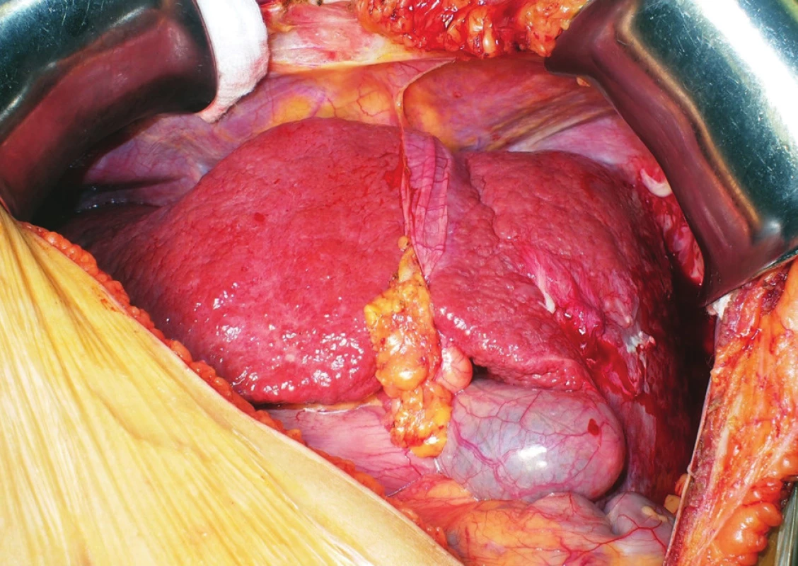 The situs inversus cirrhotic liver of the recipient before
explantation
