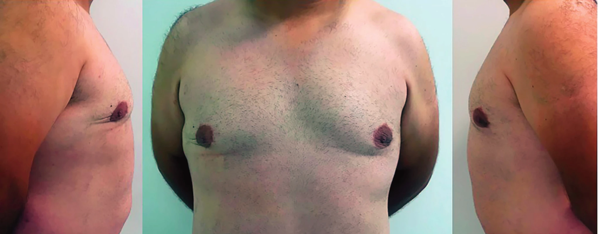 Postoperative result after 1 year