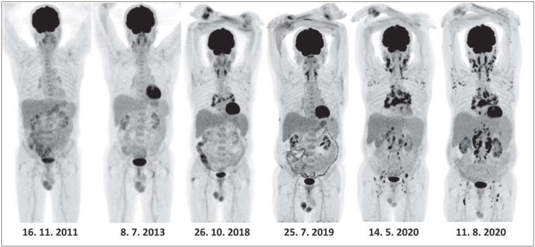 Postupný vývoj lymfadenopatie v průběhu sledování při PET/CT zobrazení za období 2011–2020.