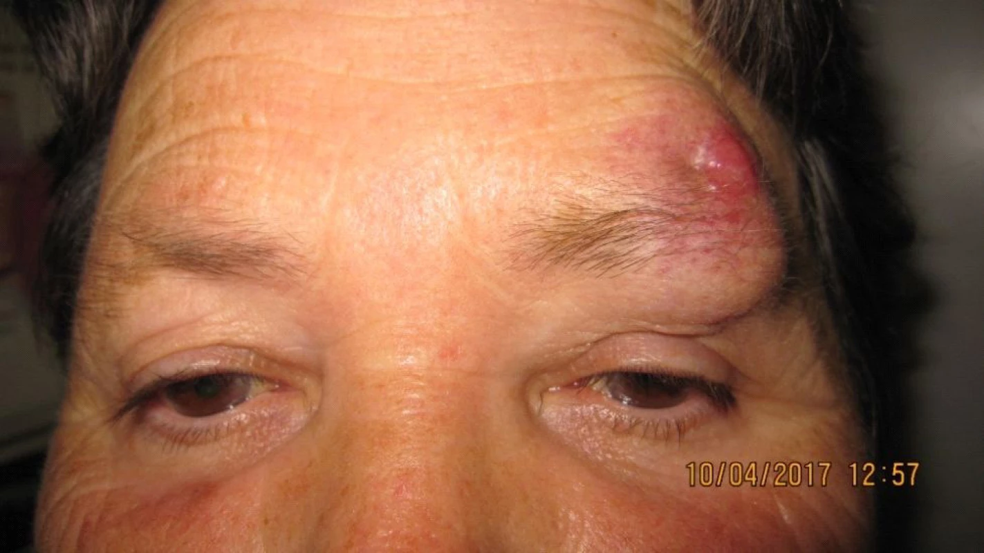 Clinical findings Patient 2 after repeated excisions in upper
eyelid and supercilium due to “oedema”