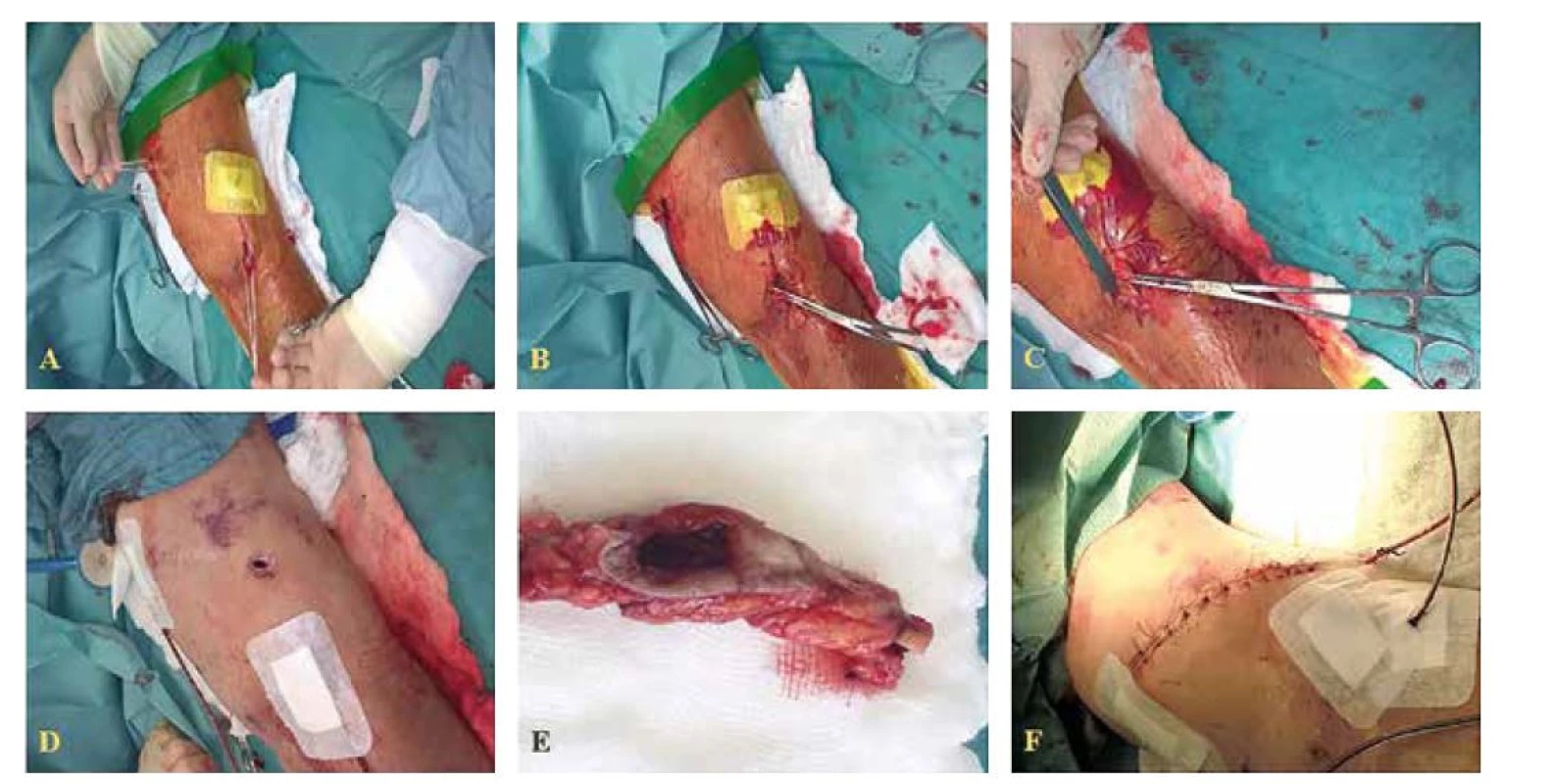 Postup parciální resekce AVG<br>
Fig. 5: AVG – partial resection procedure