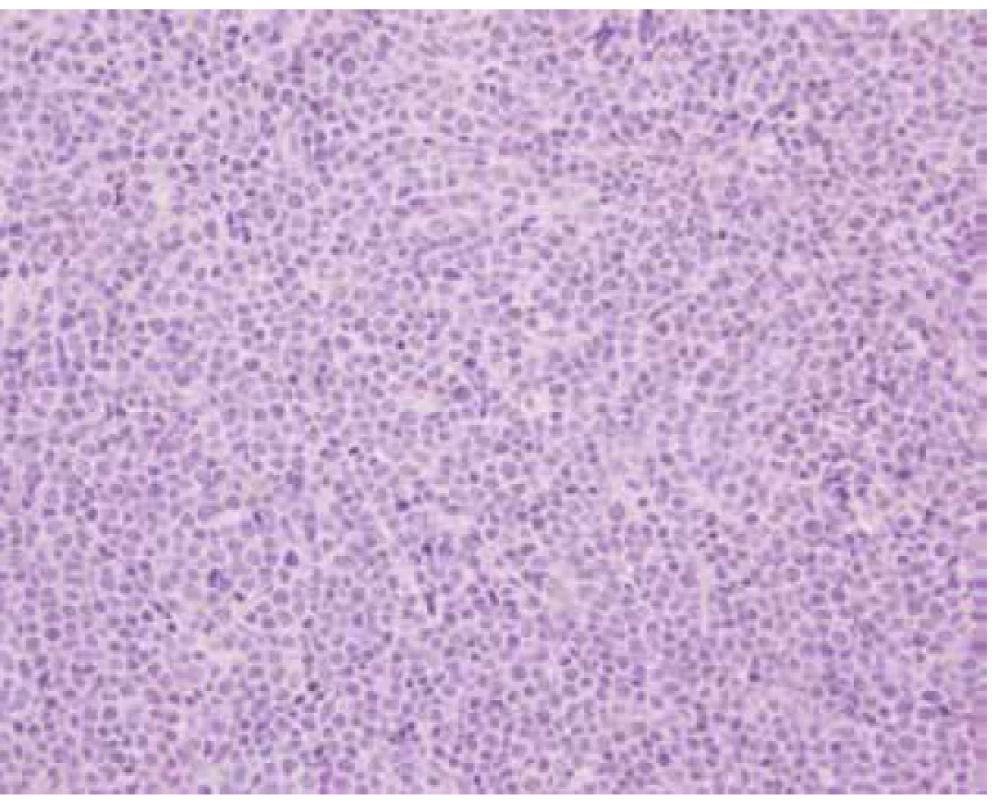 B-lymfom – základní barvení hematoxylin eozin,
400x zvětšeno<br>
Fig. 6. B-lymphoma – hematoxylin and eosin stain enlarged,
400 times