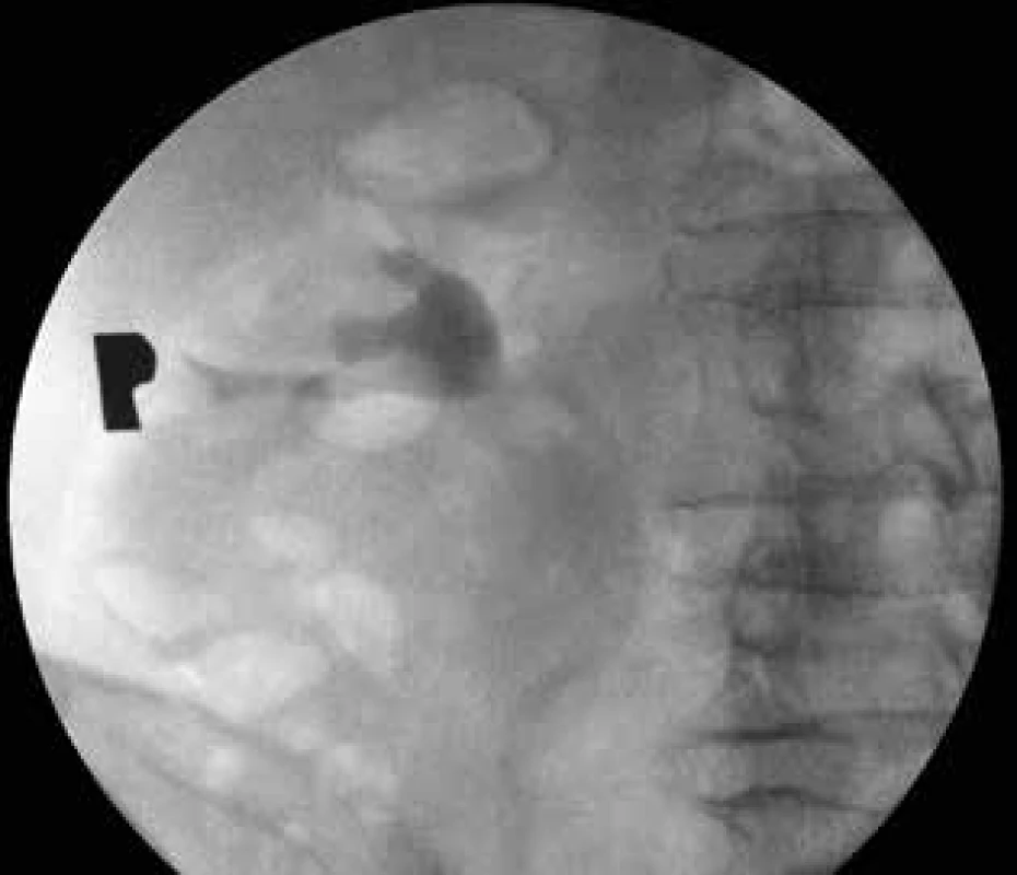 Ascendentní pyelografie – chybí náplň kontrastní
látkou v horním kalichu pravé ledviny <br>
Fig. 7: Ascendent pyelography – absent contrast agent
filling in the upper calyx of the right kidney