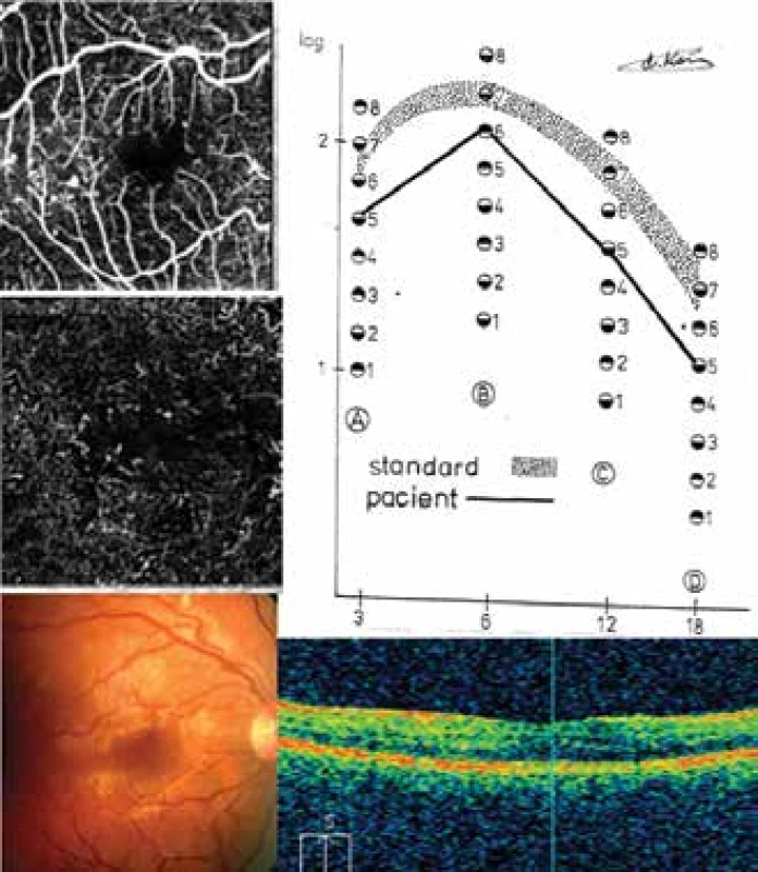 NPDR: CS, SD-OCT, OCT-A a fundus u pacienta 16
(Tabulka 2)
